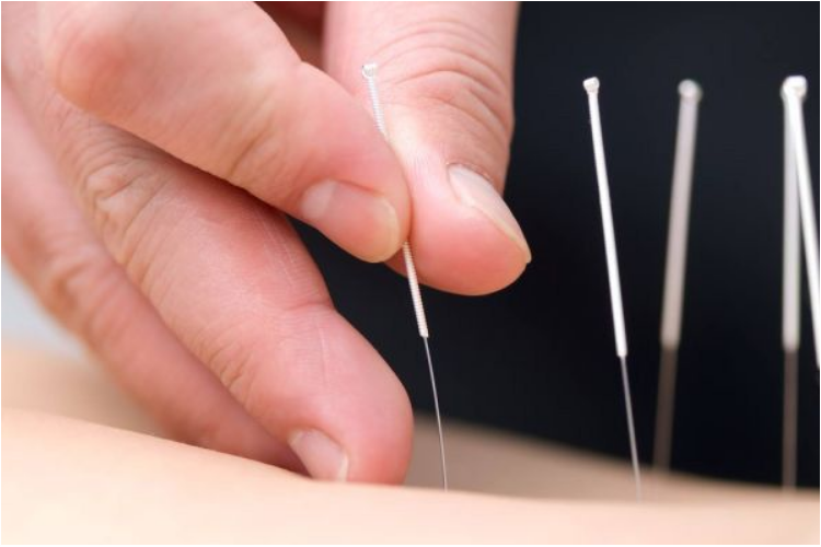 Điện mãng châm điều trị hội chứng thắt lưng hông